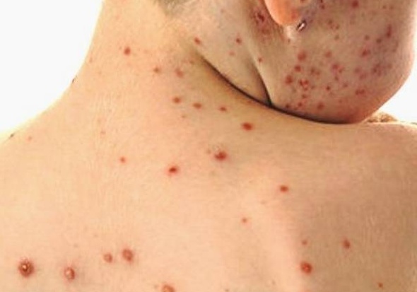 Morbillo: Italia seconda per numero di casi in Europa