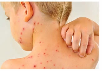 Germania: primo decesso per morbillo
