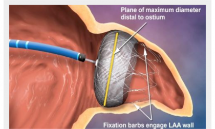 Impiantato ombrellino che salva dall’ictus