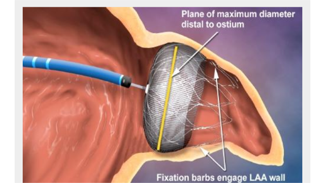 Impiantato ombrellino che salva dall’ictus