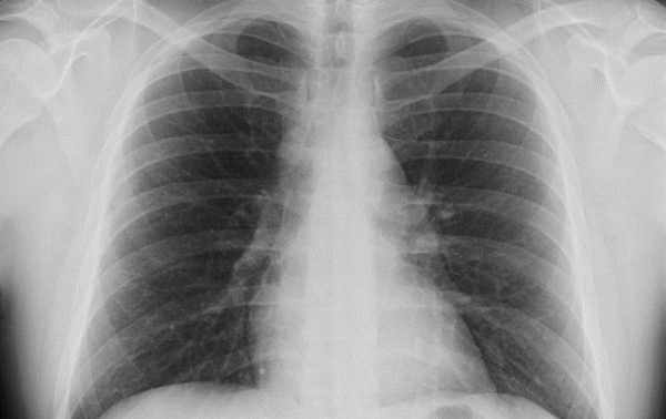 “Avevo la polmonite ma la guardia medica di Arona mi ha rimandato a casa”