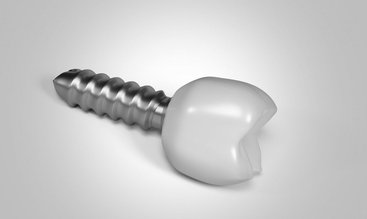 Implantologia dentale: a Novara in poche ore si può ritrovare il sorriso!