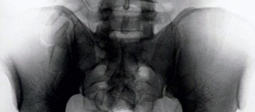 Malpensa fermato per ovuli di coca nello stomaco ma erano fagioli