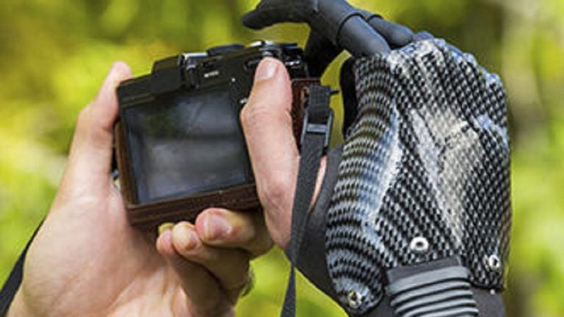 Mano bionica sostituisce quella persa per un petardo