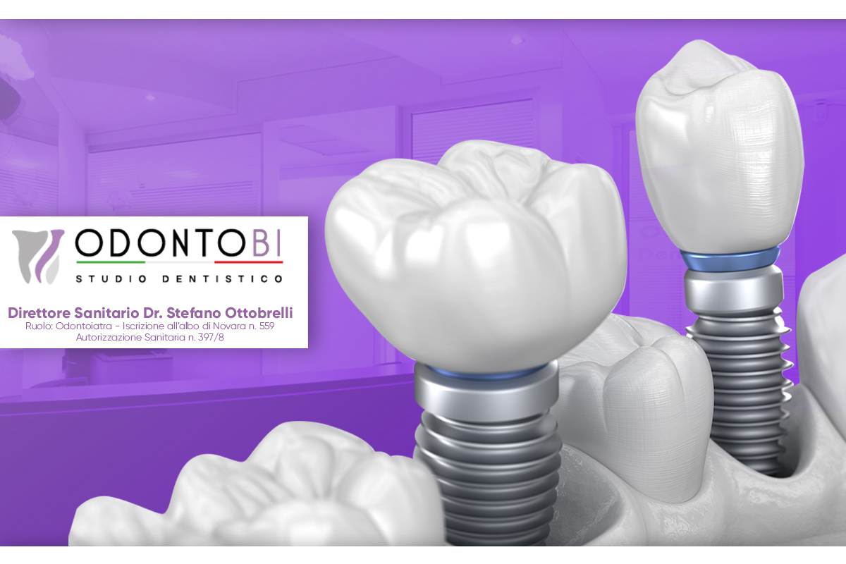 Tornare a sorridere in 24 ore: come funzionano gli impianti dentali a carico immediato