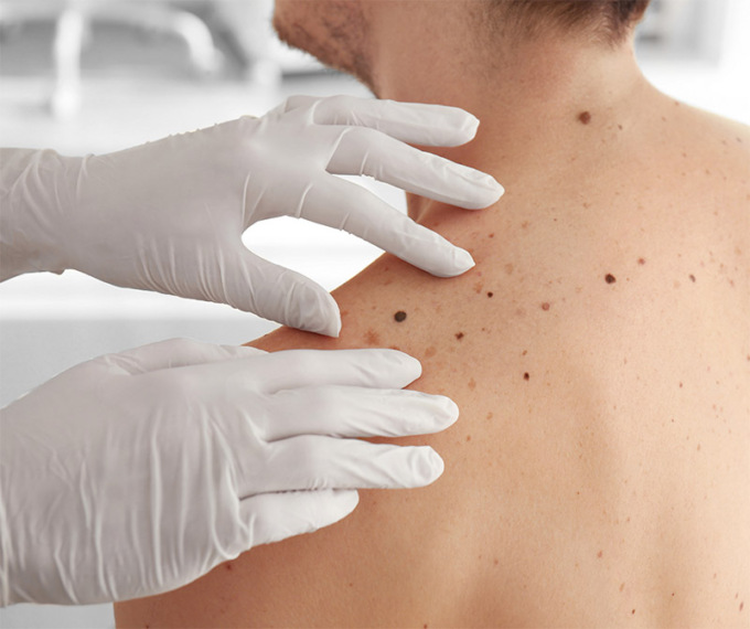 Salva la tua pelle: campagna di prevenzione del melanoma cutaneo