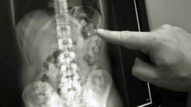 Aveva 92 ovuli di cocaina nello stomaco: arresti a Malpensa