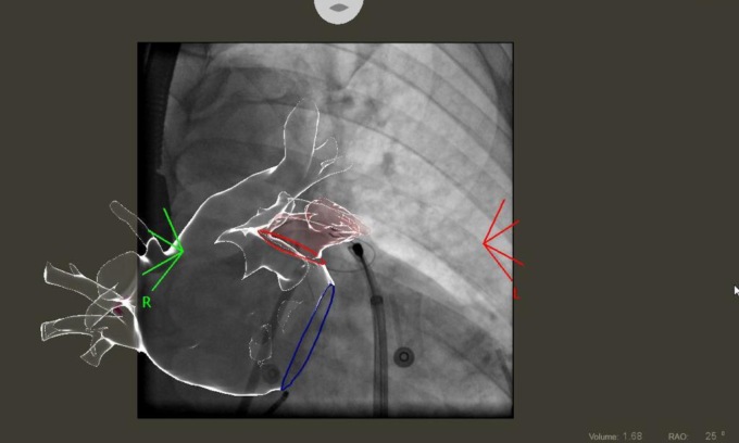 Per la prima volta al mondo effettuato un intervento combinato mini-invasivo