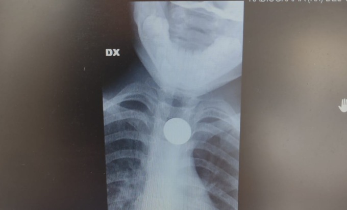 Bimbo ingoia una monetina: ore da incubo prima dell’intervento