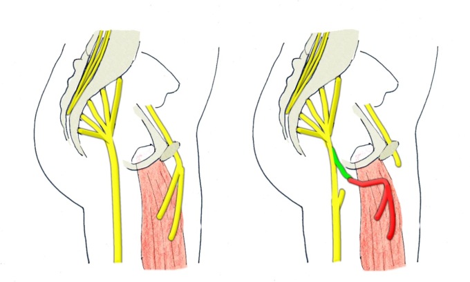 Bimbo di 2 anni sottoposto ad intervento unico in Europa per ripristinare la funzione di un arto paralizzato