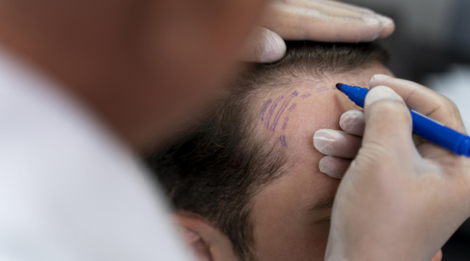 Fattori da considerare nella scelta di una clinica per il trapianto